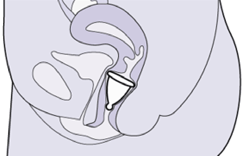 La coupe menstruelle